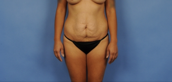 25-34 year old woman treated with Tummy Tuck before 3781676