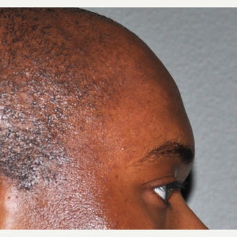 25-34 year old man treated with Forehead Augmentation after 2452909