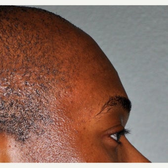 25-34 year old man treated with Forehead Augmentation before 2452909