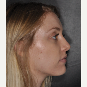 18-24 year old woman treated with Nose Surgery 1 yer post-op after 3499845