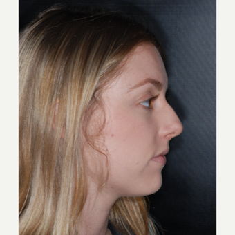 18-24 year old woman treated with Nose Surgery 1 yer post-op before 3499845