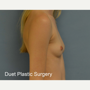 18-24 year old woman treated with Breast Augmentation before 3342236