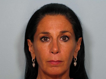 Sculptra after 460591