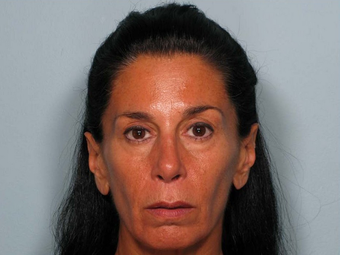 Sculptra before 460591