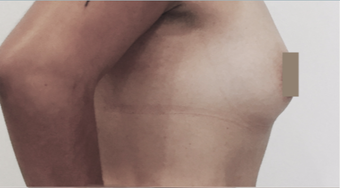 18-24 year old woman treated with Breast Augmentation before 3815499