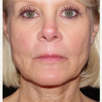 55-64 year old woman treated with ArteFill before 3645768