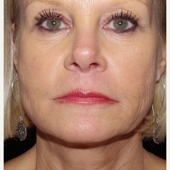 55-64 year old woman treated with ArteFill after 3645768