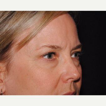 50 year old woman undergoes upper and lower blepharoplasty before 3439865