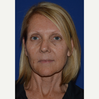 55-64 year old woman treated with Facelift before 3768668