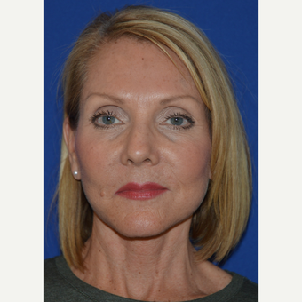 55-64 year old woman treated with Facelift after 3768668