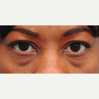 Restylane can improve dark circles, hollowness, and fat pockets in the lower eyelids before 2345294
