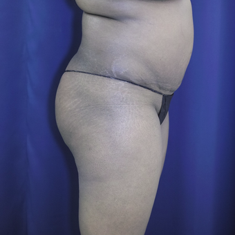 35-44 year old woman treated with Brazilian Butt Lift before 3305202