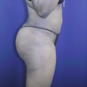 35-44 year old woman treated with Brazilian Butt Lift after 3305202