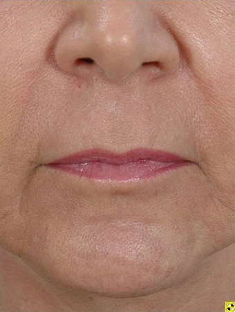 Fractional Resurfacing after 230841