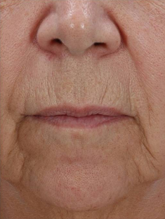 Fractional Resurfacing before 230841