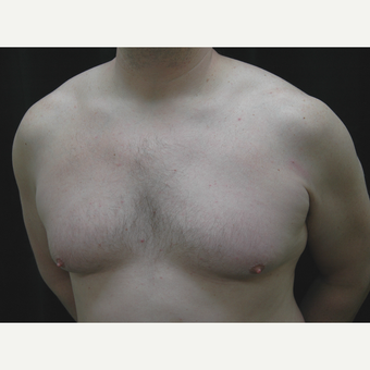 35-44 year old man treated with Male Breast Reduction before 3181910