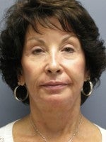 65-74 year old woman treated with Neck Lift before 3103883