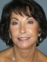 65-74 year old woman treated with Neck Lift after 3103883