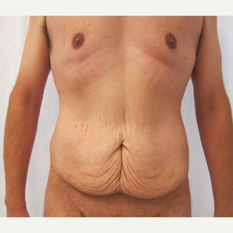 25-34 year old man treated with Tummy Tuck before 3297982