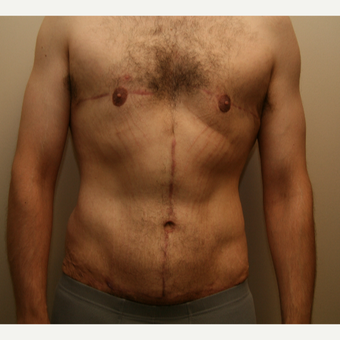 25-34 year old man treated with Tummy Tuck after 3297982