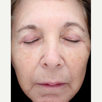68 year old woman treated with Halo Laser before 3656509
