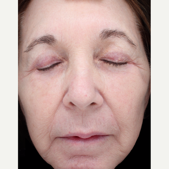 68 year old woman treated with Halo Laser after 3656509
