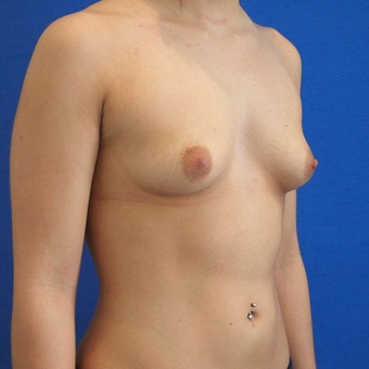 18-24 year old woman treated with Breast Augmentation before 3497300