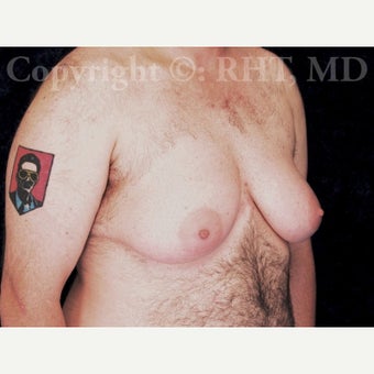 30 yo F-M transgender patient man received "top surgery" mastectomies and NAC reductions for Chest Masculinization 1921228