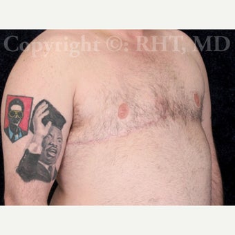 30 yo F-M transgender patient man received "top surgery" mastectomies and NAC reductions for Chest Masculinization 1921228
