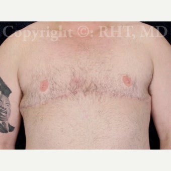 30 yo F-M transgender patient man received "top surgery" mastectomies and NAC reductions for Chest Masculinization after 1921228