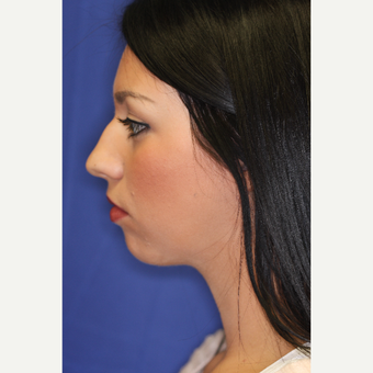 25-34 year old woman treated with Chin Liposuction after 3260026