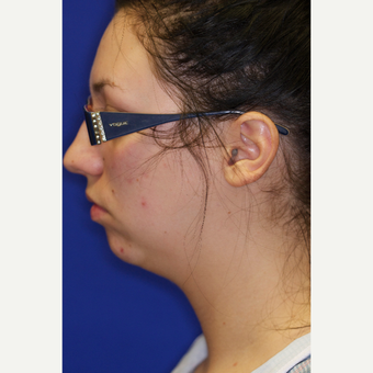 25-34 year old woman treated with Chin Liposuction before 3260026
