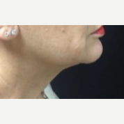 55-64 year old woman treated with Kybella to the anterior Neck after 3369733