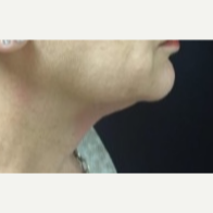55-64 year old woman treated with Kybella to the anterior Neck before 3369733