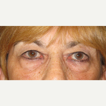 Upper Blepharoplasty before 3084677