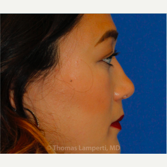 25-34 year old woman treated with Asian Rhinoplasty after 3703778