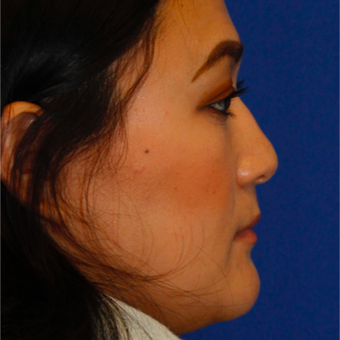 25-34 year old woman treated with Asian Rhinoplasty before 3703778