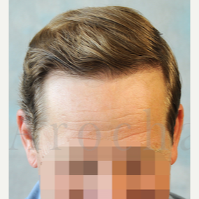 Middle Age man treated with 3000+FUSS Hair Transplant after 3320350