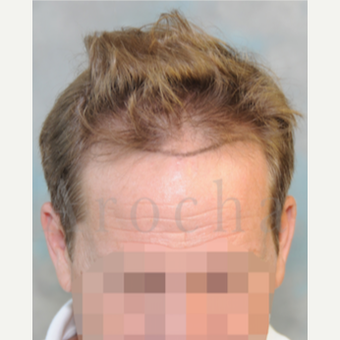 Middle Age man treated with 3000+FUSS Hair Transplant before 3320350