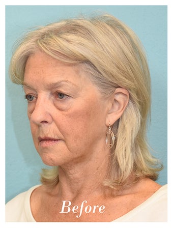 65-74 year old woman treated with Eye Bags Treatment before 3577913