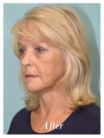 65-74 year old woman treated with Eye Bags Treatment after 3577913
