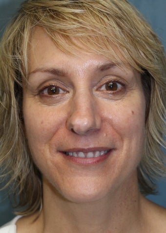 49 Year Old Female Had Nose Reshaping 1105110