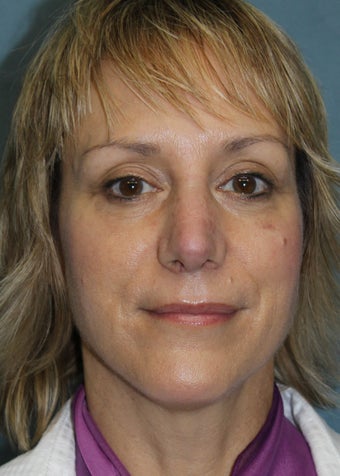 49 Year Old Female Had Nose Reshaping 1105110