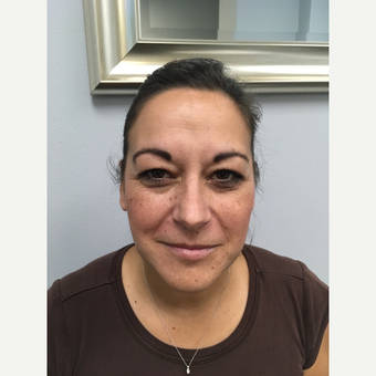 35-44 year old woman treated with Lip Augmentation before 3684530