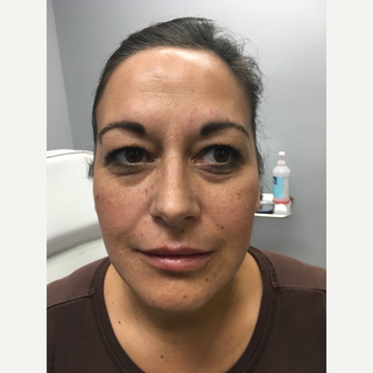 35-44 year old woman treated with Lip Augmentation after 3684530