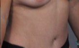 42 year old woman treated with Tummy Tuck after 3287371