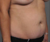 42 year old woman treated with Tummy Tuck before 3287371