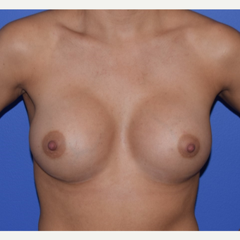 25-34 year old woman treated with Breast Augmentation after 3079180
