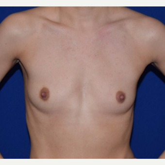 25-34 year old woman treated with Breast Augmentation before 3079180