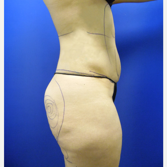 25-34 year old man treated with Butt Implants before 3851719